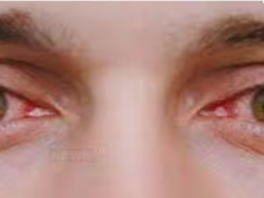 प्रदूषण से आंखों में हो रहीं ये दो बीमारियां, इन लक्षणों को न करें इग्नोर, ये 4 उपाय करेंगे पॉल्यूशन से बचाव